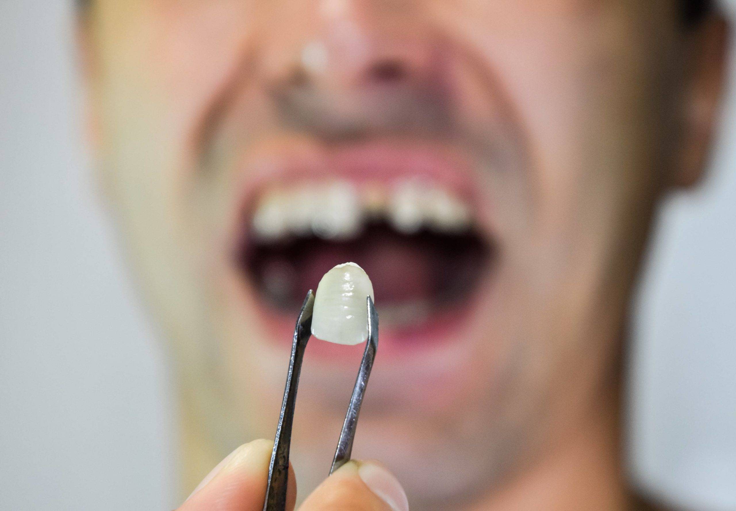 The Best Treatment To Replace Missing Teeth