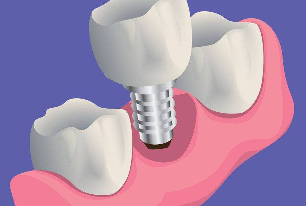 Does It Hurt To Get A Dental Implant?