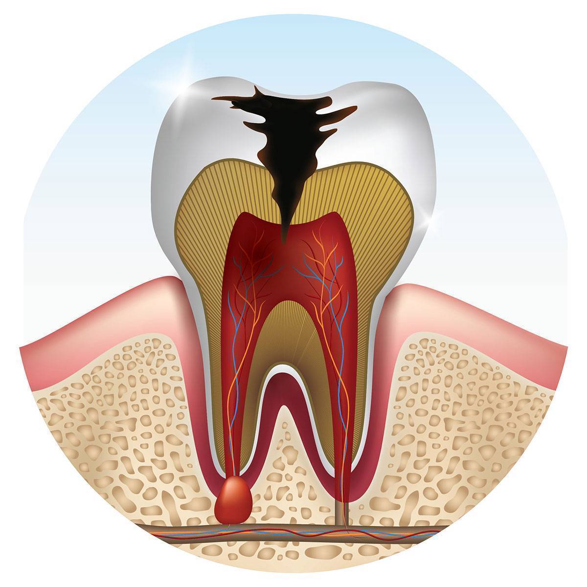 The Differences in Cavities, Decay & Caries