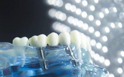 The Dental Issues That Needs Dental Implant