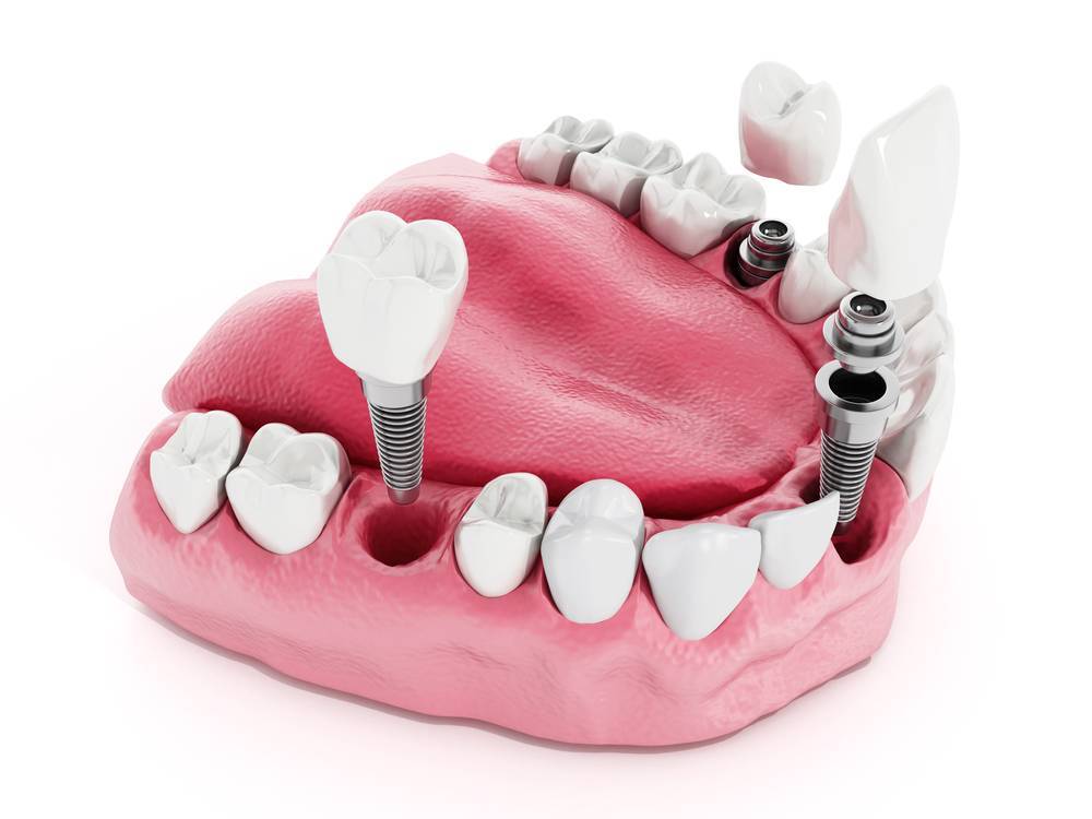 Preventing Infection In Dental Implants