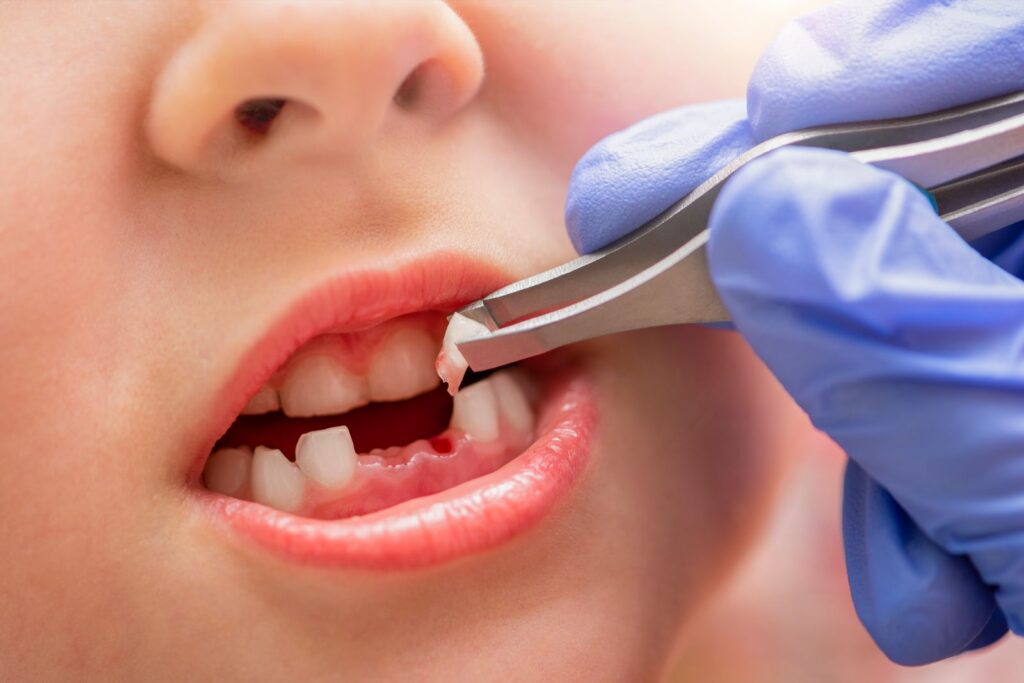 Smile Esthetics | What to know about tooth extraction