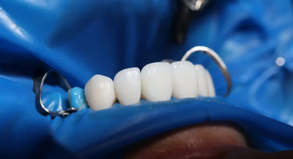 Installation of veneers and dental implants