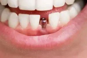 Dental Implant