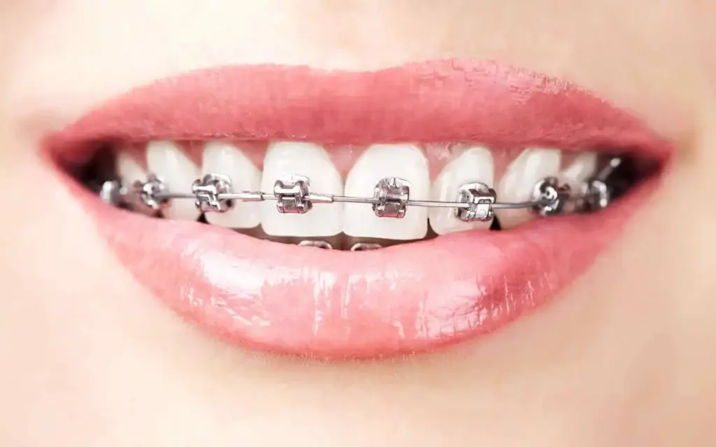 Braces