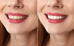 Before and after