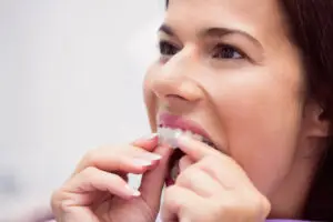 Smile Esthetics | Veneers vs Bonding vs Invisalign  Which is Right for Your Smile Makeover